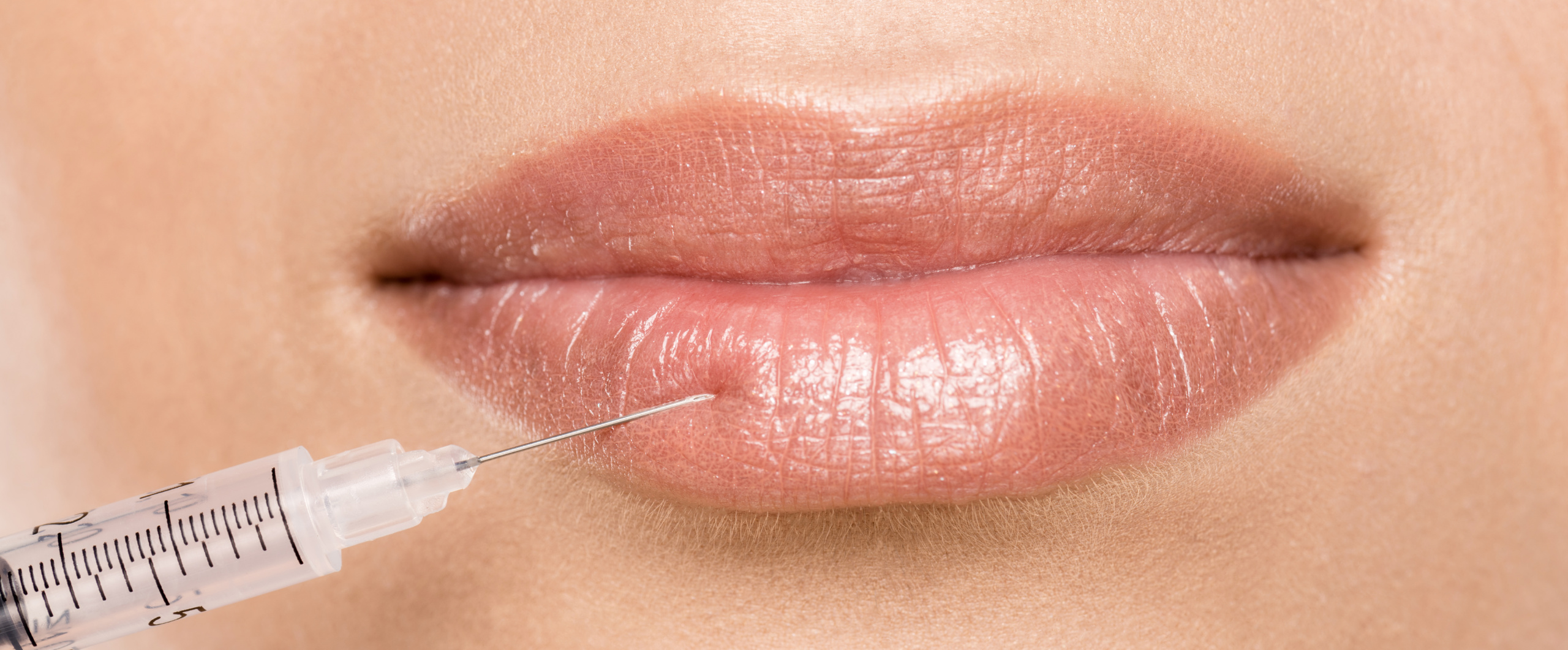 filler labbra napoli
