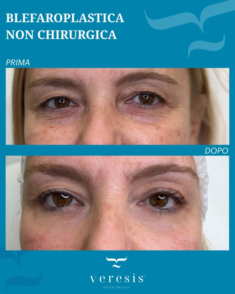 Blefaroplastica non chirurgica