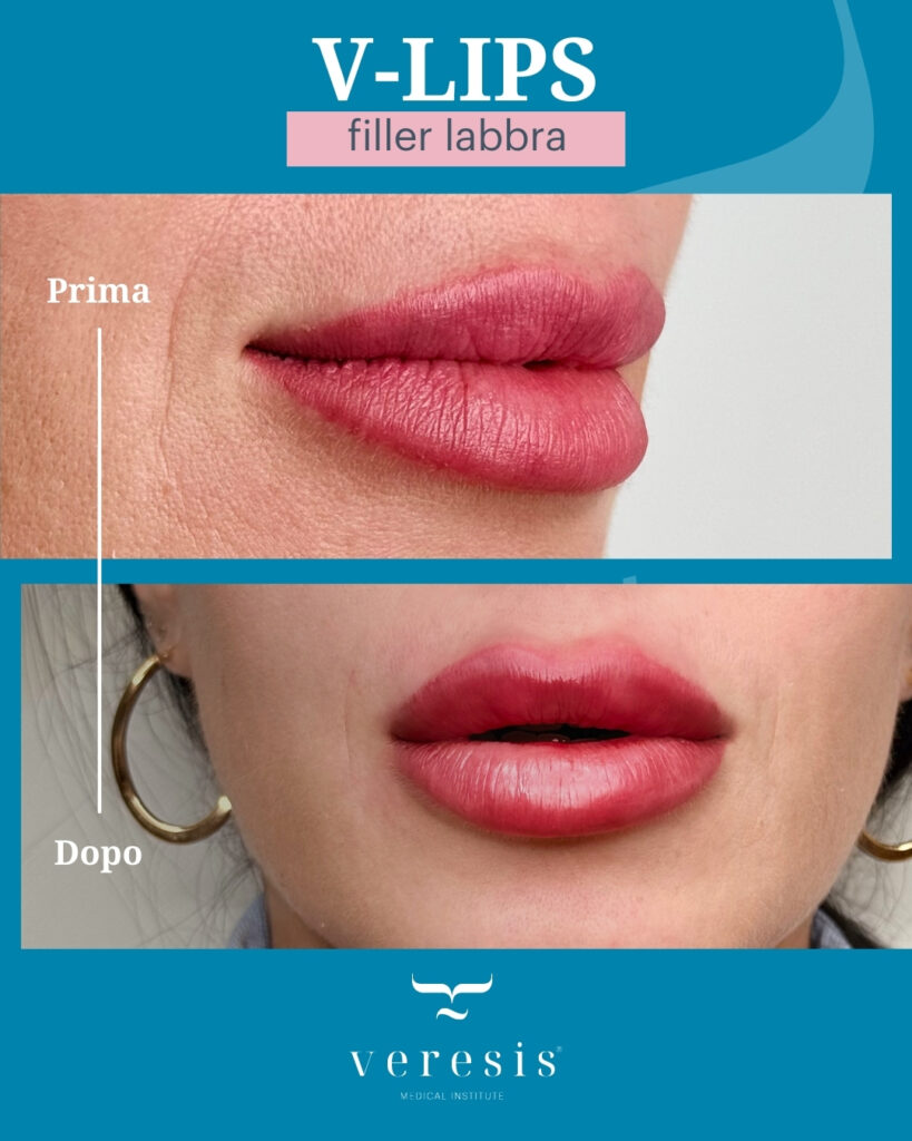 filler labbra prima e dopo