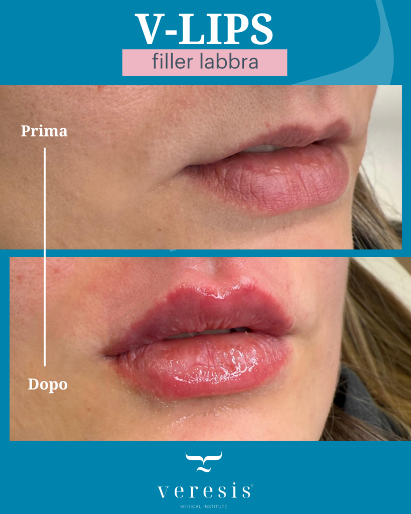 filler labbra prima e dopo